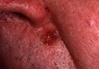 Cancer cutané - Dermatologues à Angers