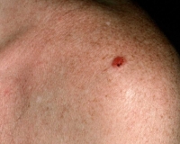 Carcinome baso-cellulaire - Dermatologues à Angers