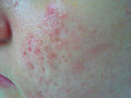 Dermatologue Angers - Cicatrices d'acné