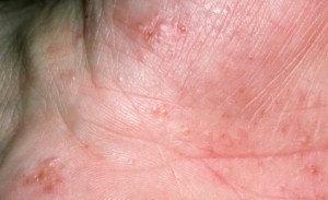 Eczéma - Cabinet dermato à Angers