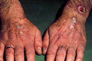 Keratose des mains - Dermatologues à Angers