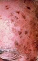 keratoses solaires - Dermatologues à Angers