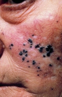 Mélanome - Dermatologues à Angers