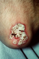 Psoriasis - Cabinet dermato à Angers