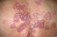 Psoriasis - Cabinet dermato à Angers