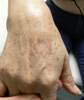 Avant traitement des tâches par laser - Cabinet dermato à Angers