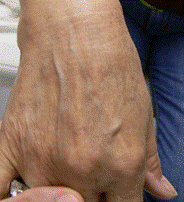 Après traitement des tâches par laser - Cabinet dermato à Angers