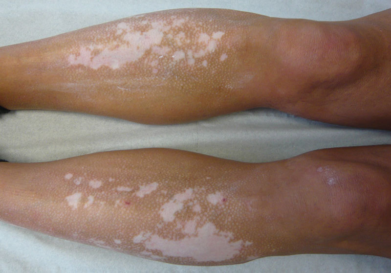 Vitiligo - Cabinet dermato à Angers