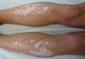 Dermatologue Angers - Vitiligo